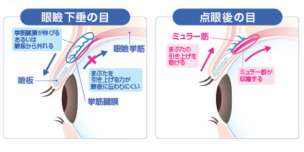 眼瞼下垂